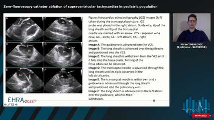 Zero-fluoroscopy catheter ablation of supraventricular tachycardias in pediatric population