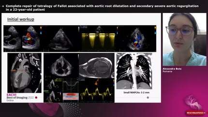 Complete repair of tetralogy of Fallot associated with aortic root dilatation and secondary severe aortic regurgitation in a 22-year-old patient