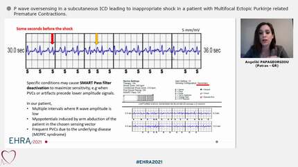P wave oversensing in a subcutaneous ICD leading to inappropriate shock in a patient with Multifocal Ectopic Purkinje related Premature Contractions.