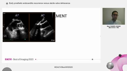 Early prosthetic endocarditis recurrence versus sterile valve dehiscence.