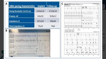 Performance at mid-term follow-up of traditional high voltage leads implanted in the left bundle branch area