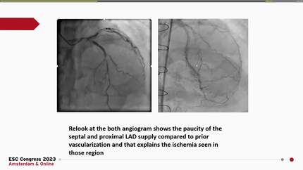 Do you see what I see? Does the cardiac magnetic resonance imaging finding correlate with the coronary angiogram finding?