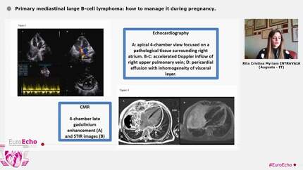 Primary mediastinal large B-cell lymphoma: how to manage it during pregnancy.