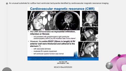 An unusual substrate for outflow tract ventricular tachycardia identified by cardiovascular magnetic resonance imaging.