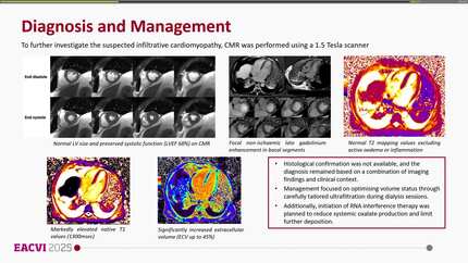Cardiac involvement in systemic oxalosis detected by cardiac magnetic resonance: a case of restrictive cardiomyopathy in primary hyperoxaluria