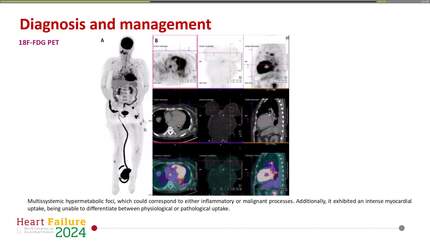 A rare presentation of disseminated micronodular melanoma masquerading as an infiltrative cardiomyopathy.