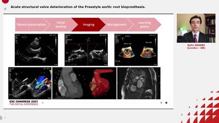 Acute structural valve deterioration of the Freestyle aortic root bioprosthesis.
