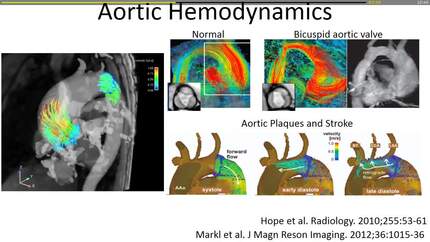 Current trends in 4D flow MRI: towards clinical application.