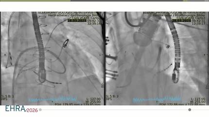 Successful catheter ablation of electrical storm with the lattice tip catheter in a patient with a left ventricular apical thrombus using echocardiographic guidance