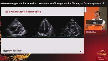 Overcoming pericardial adhesions: a case report of intrapericardial fibrinolysis for management of acute nonpurulent pericarditis complicated by large multiloculated pericardial effusion.