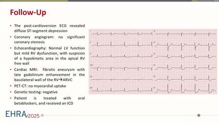 Atropine use in unstable monomorphic ventricular tachycardia