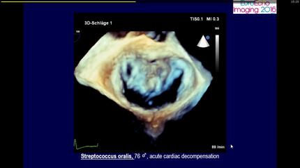Endocarditis.