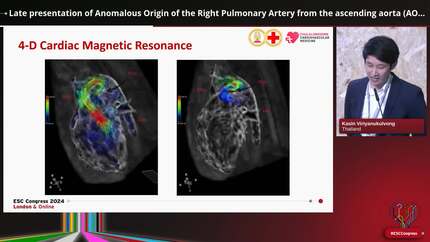 Late presentation of Anomalous Origin of the Right Pulmonary Artery from the ascending aorta (AORPA)