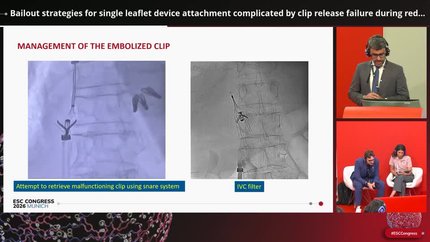 Bailout strategies for single leaflet device attachment complicated by clip release failure during redo transcatheter mitral repair