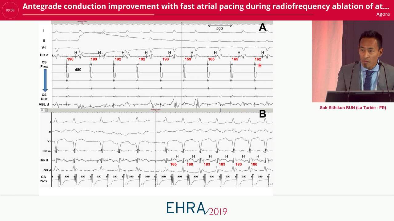 Antegrade conduction improvement with fast atrial pacing during radiofrequency ablation of atrioventricular nodal re-entrant tachycardia to predict slow pathway conduction disappearance