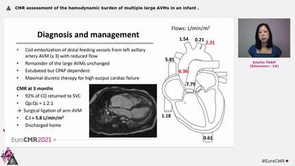 CMR assessment of the hemodynamic burden of multiple large AVMs in an infant
.