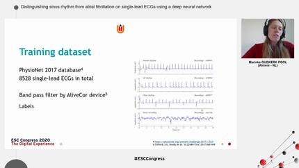 Distinguishing sinus rhythm from atrial fibrillation on single-lead ECGs using a deep neural network