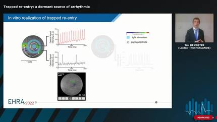 Trapped re-entry: a dormant source of arrhythmia
