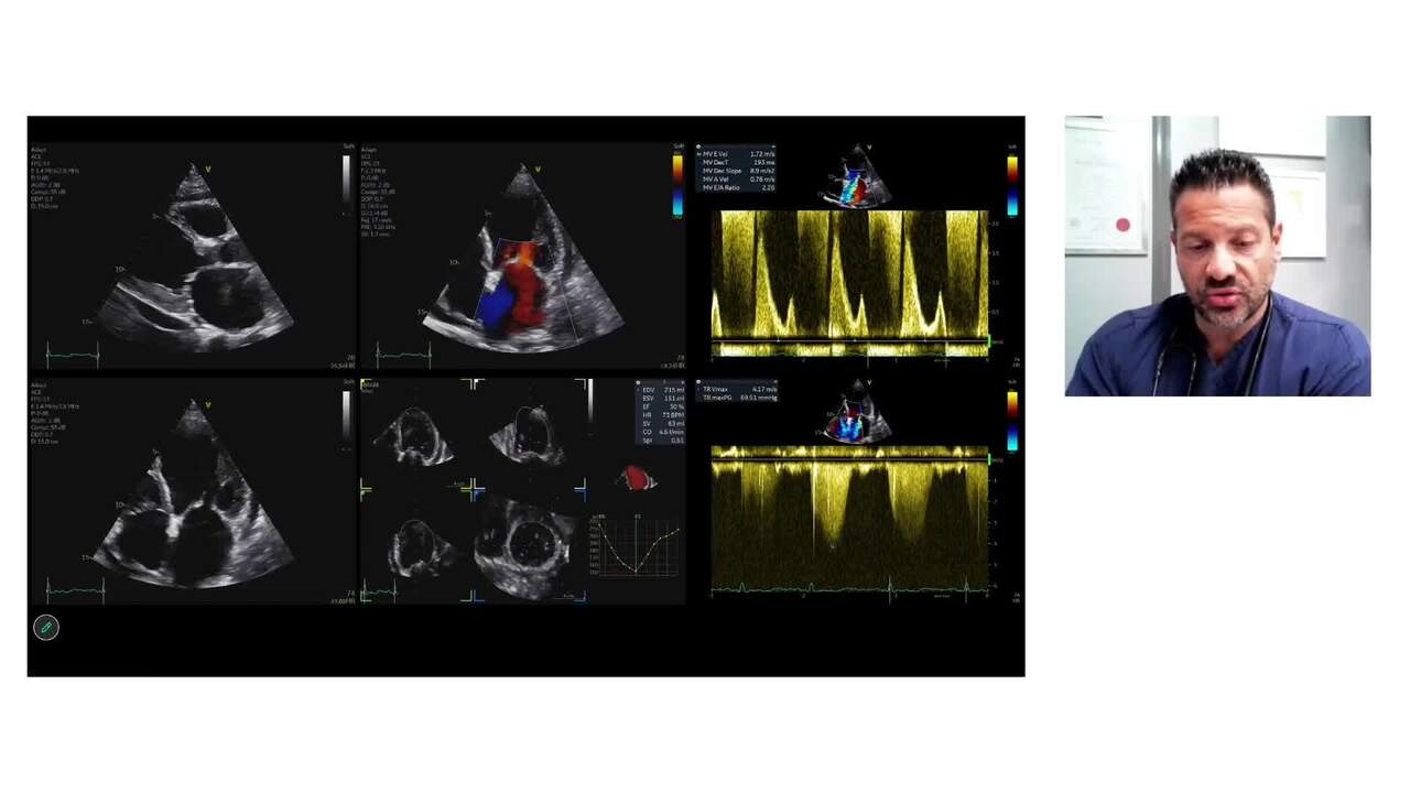 Mitral regurgitation: from diagnosis to transcatheter treatment in light of 2025 ESC Valvular Heart Disease Guidelines