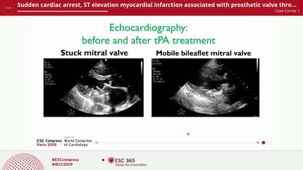 Sudden cardiac arrest, ST elevation myocardial infarction associated with prosthetic valve thrombosis responding to tPA treatment.