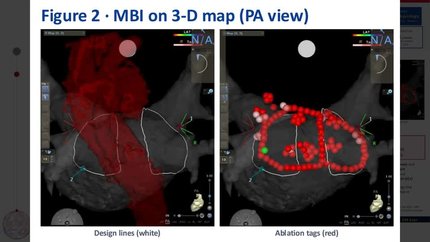 Association between modified box isolation with a posterior centreline and atrial fibrillation ablation outcomes in patients with left atrial enlargement