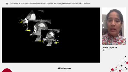 Case - Acute pulmonary embolism or chronic thromboembolic pulmonary hypertension?