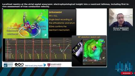 Localized reentry at the atrial septal aneurysm: electrophysiological insight into a reentrant isthmus, including first in-vivo assessment of true conduction velocity.