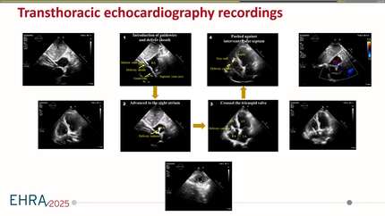 Leadless pacemaker (1)