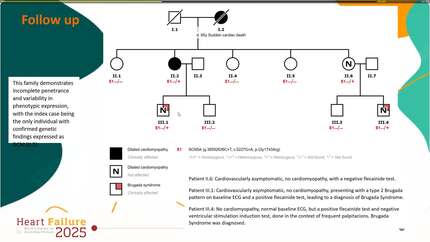 A new phenotypic presentation of the p.Gly1743Arg variant in SCN5A classically associated with Brugada syndrome.