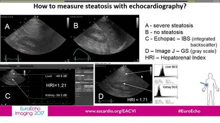 Hepatic steatosis assessed quantitatively with echocardiography correlates with liver biopsy in severely obese patients