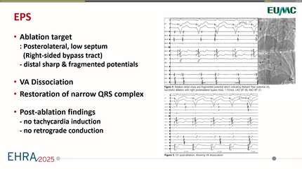 A rare case of Mahaim fiber-mediated AVRT with LBBB morphology: diagnosis and successful ablation