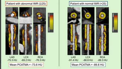 Usefulness of mean attenuation of pericoronary adipose tissue as a predictor of coronary microvascular dysfunction.