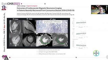 Update on CMR in patients recovering from Covid-19 infection