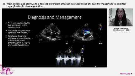From severe and elective to a torrential surgical emergency: recognising the rapidly changing face of mitral regurgitation in clinical practice.
.
