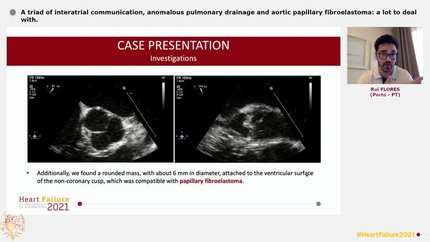 A triad of interatrial communication, anomalous pulmonary drainage and aortic papillary fibroelastoma: a lot to deal with.