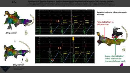 Simplification of resetting response in slow/fast atrioventricular nodal reentrant tachycardia: the 3 catheters approach