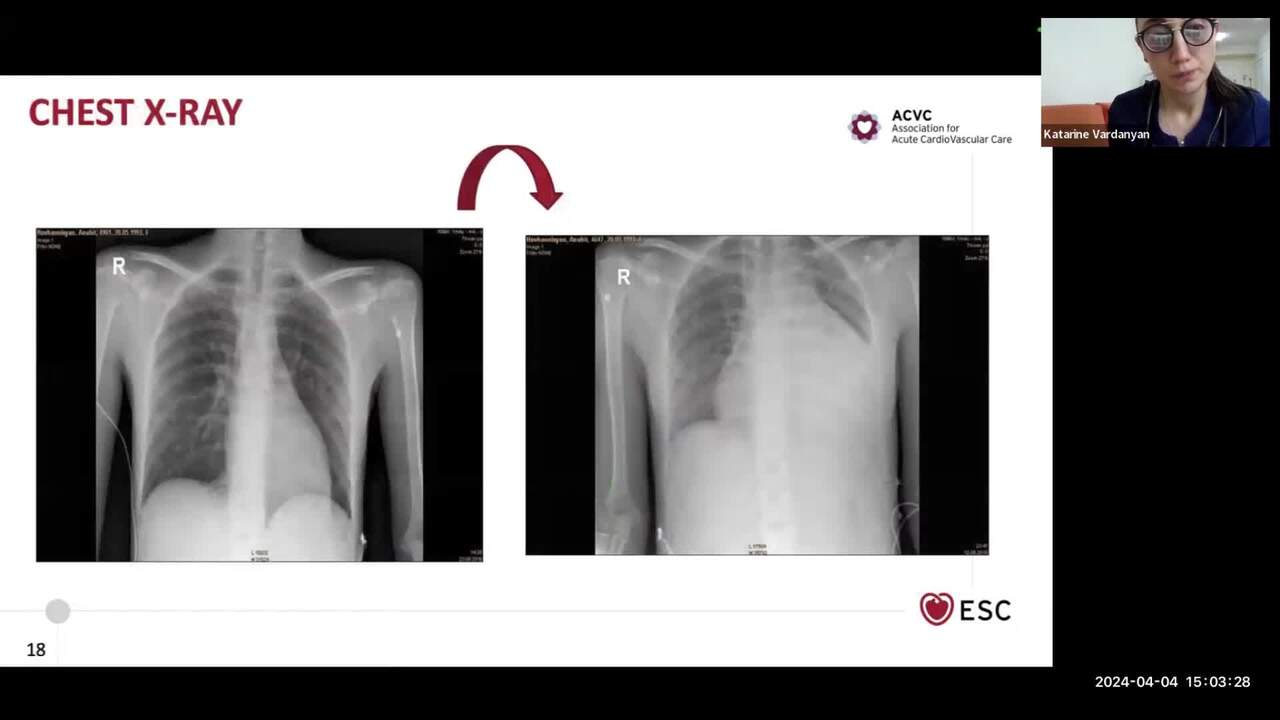 ACVC Talks - episode 4 - device therapy in acute cardiovascular disease