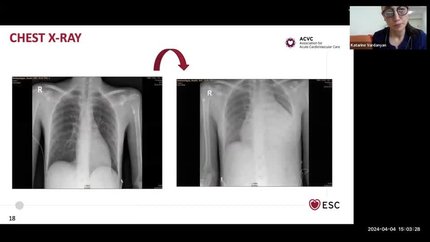 ACVC Talks - episode 4 - device therapy in acute cardiovascular disease