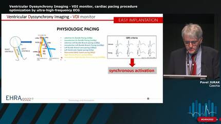 Ventricular Dyssynchrony Imaging - VDI monitor, cardiac pacing procedure optimization by ultra-high-frequency ECG