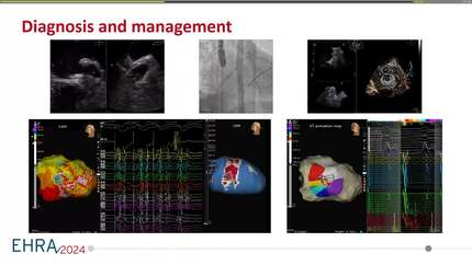 Left atrial appendage thrombus on transoesophageal echocardiography prior to ventricular tachycardia ablation. Is there a possibility of a combined treatment?