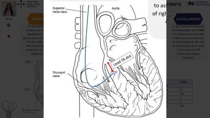 Characterization of tricuspid regurgitation in patients following left bundle branch pacing