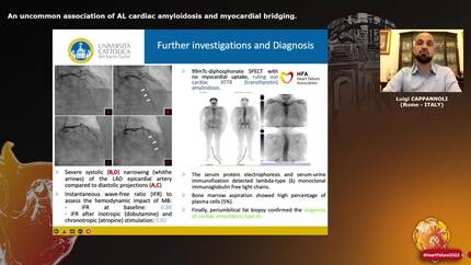 An uncommon association of AL cardiac amyloidosis and myocardial bridging.