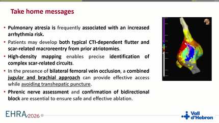 Ablation of scar-related atrial flutter in pulmonary atresia using a combined jugular and brachial access