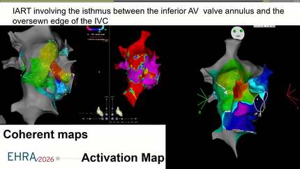 Atrial flutter ablation through Fontan's extracardiac conduit in a patient with a double-inlet single ventricle