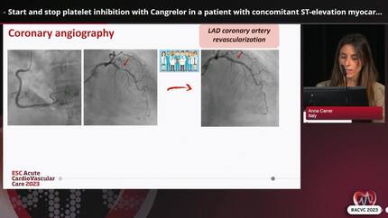 Start and stop platelet inhibition with Cangrelor in a patient with concomitant ST-elevation myocardial infarction and acute complicated cholecystitis
