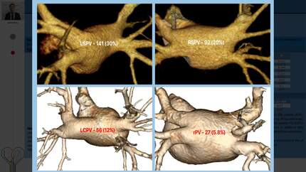 Impact of altered pulmonary vein anatomy on long-term outcomes after cryoablation of paroxysmal atrial fibrillation