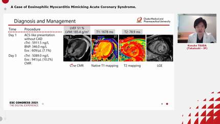 A Case of Eosinophilic Myocarditis Mimicking Acute Coronary Syndrome.