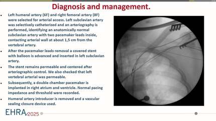 Intra-arterial pacemaker leads extraction: a case report. 