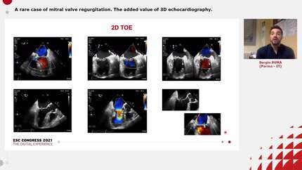 A rare case of mitral valve regurgitation. The added value of 3D echocardiography.