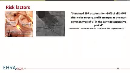 Bundle branch re-entrant ventricular tachycardia after TAVR in a patient with transthyretin cardiac amyloidosis